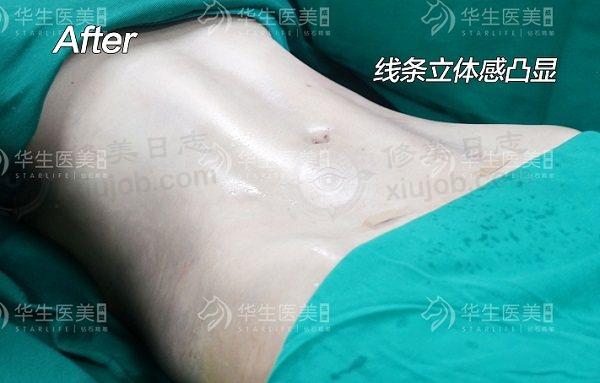 成都华生铂悦医疗美容门诊部成都华生铂悦吸脂项目