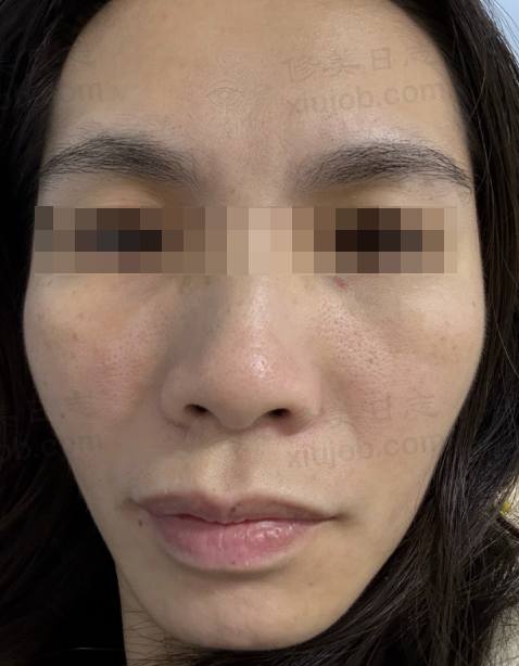 我被毛孔粗大卡粉困扰多年，黄金微针一周就让我逆袭！ 