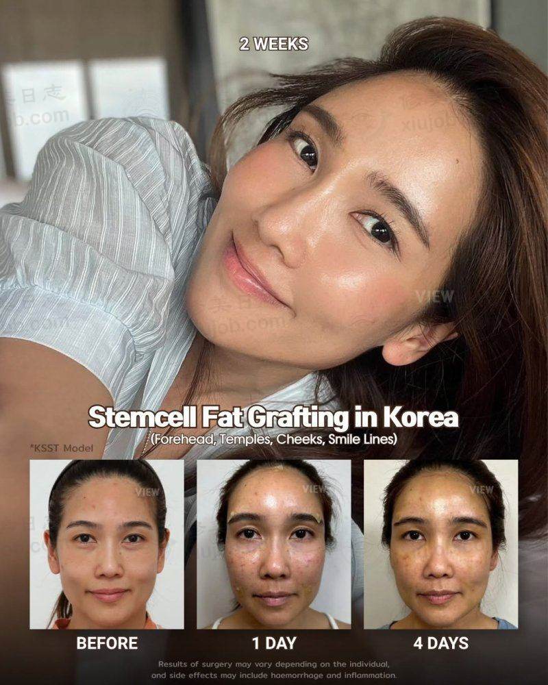 被高颧骨方下颌困扰多年，我在必妩整形重获自信美脸！ 